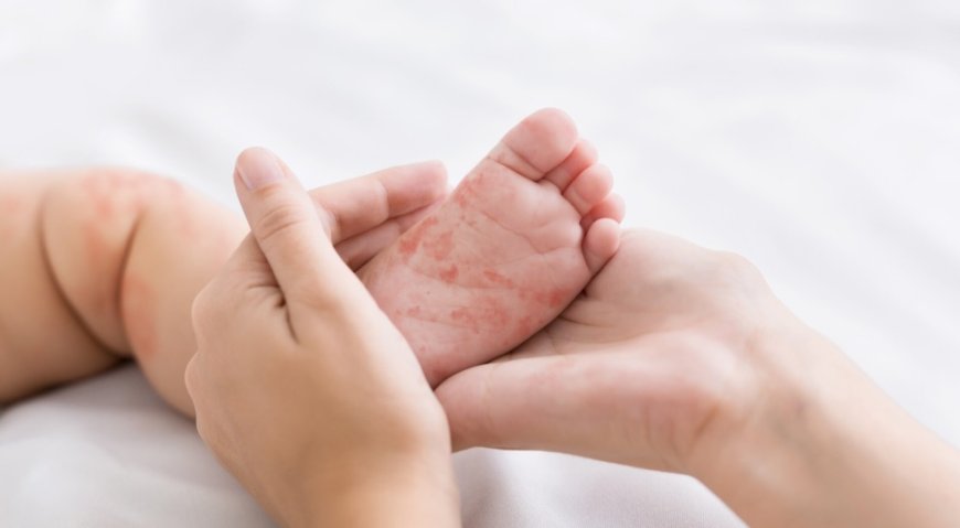 Çocuğumda Alerji Olabilir mi? Belirtiler ve Korunma Yolları